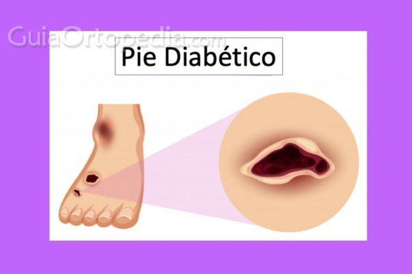 Pie Diabetico: Que es y Como Tratarlo