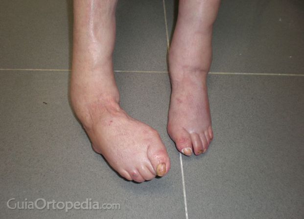 Problemas de pies